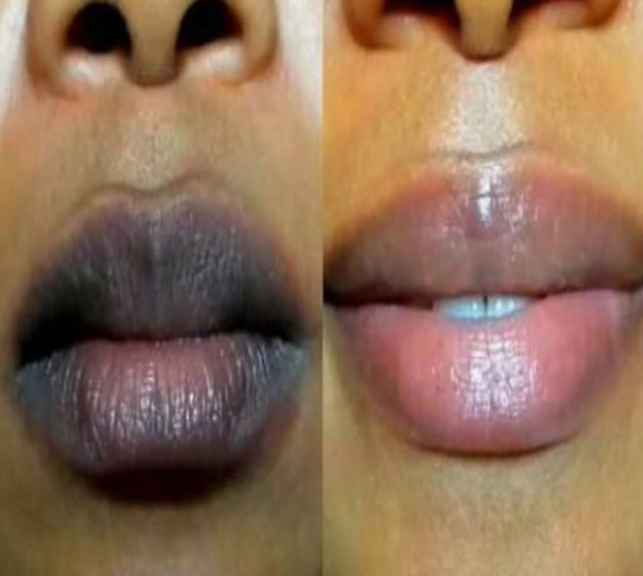 Stalideram Brand Pink Lip Injection Treatment Serum Derma Microneedling Mesotherapy Lip Repair Essence