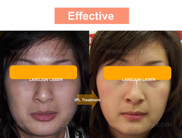 Painless IPL Laser Hair Removal Machine For Full Body / Face Skin Lightening