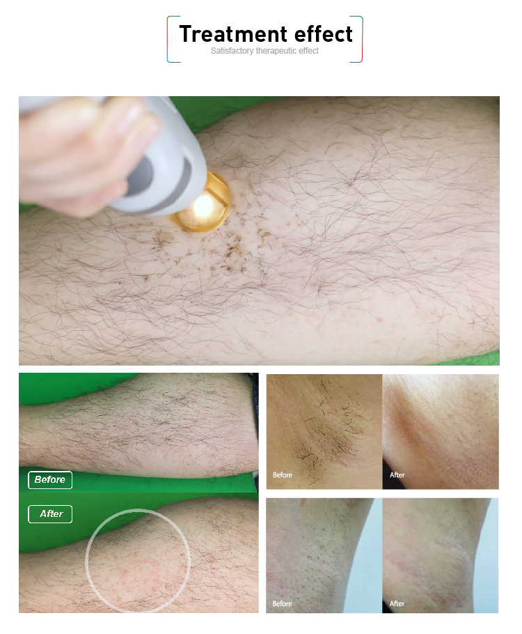 755nm 1064nm Newest Model Gentle Alex Laser Hair Removal Machine with ND Yag Laser
