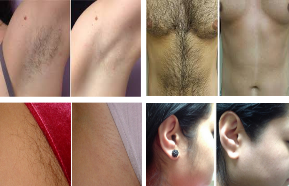 1200w Sincoheren 808nm Diode Laser Hair Removal Machine