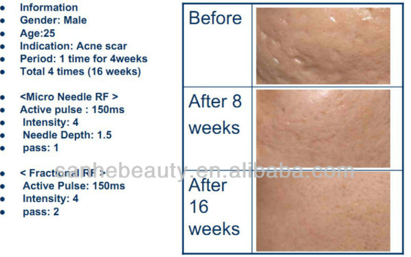 Micro Needle RF Fractional Skin Resurfacing Machine , Acne Scar Removal Machine