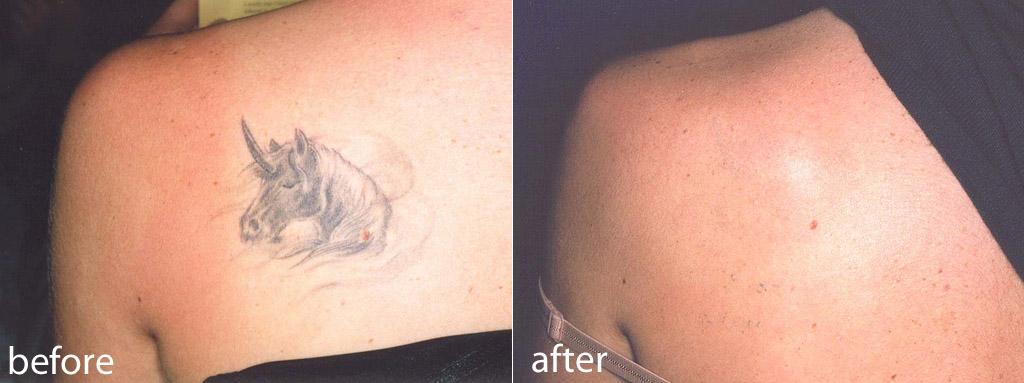 Q Switched ND-yag laser machine for skin clear pigment removal