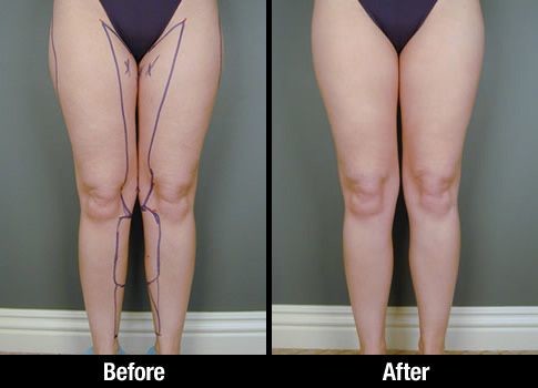 Cryo Freezing Cryolipolysis Body Slimming Machine , Weight Reduction Equipment