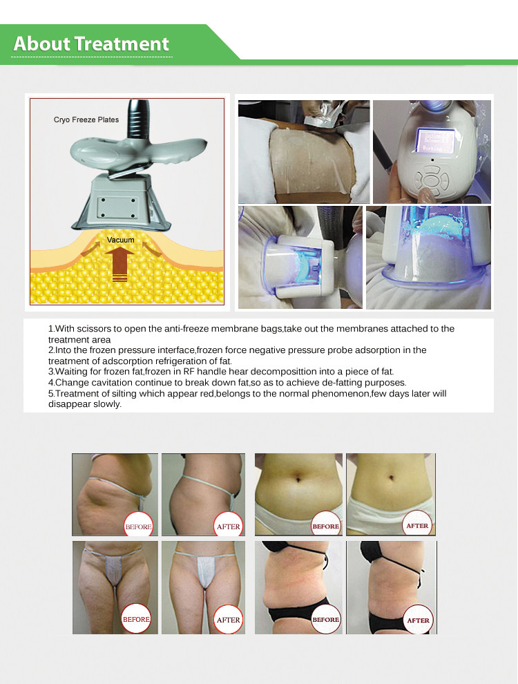 LF-217 Salon use fat reducing cryo portable slimming machine with 2 cryo handles