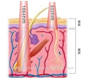 tattoo removal laser.jpg