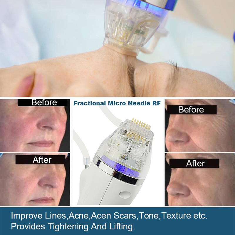 Micro Needle RF Radio Frequency Machine 2 In 1 Cold Hammer Facial Lifting Skin Treatment