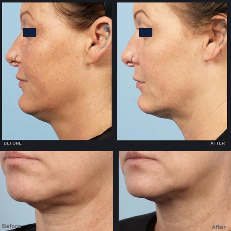 Microneedling RF Fractional Radio Frequency Beauty Equipment Facelift Skin Tight