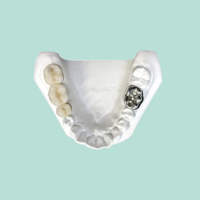 The Color Of The Porcelain Crown Is Stablenot And Has Strong Stability