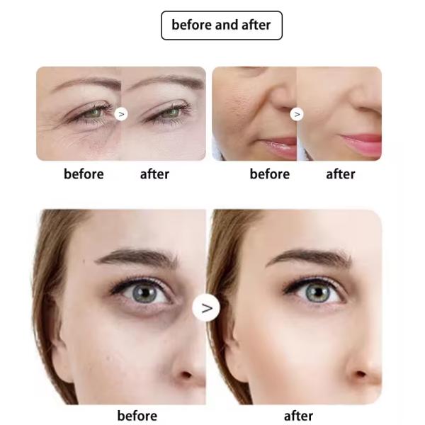 3D HIFU Machine for Non-Surgical Face & Body Lifting – Skin Tightening Treatment