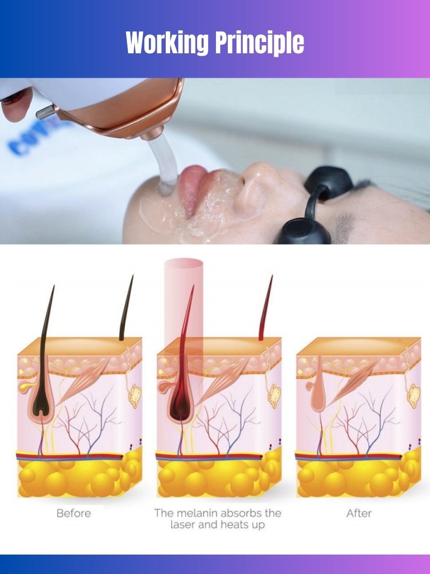 808 Diode Laser Hair Removal Machine Facial Skin Rejuvenation 808 755 1064Nm Laser Diode 808 Nm