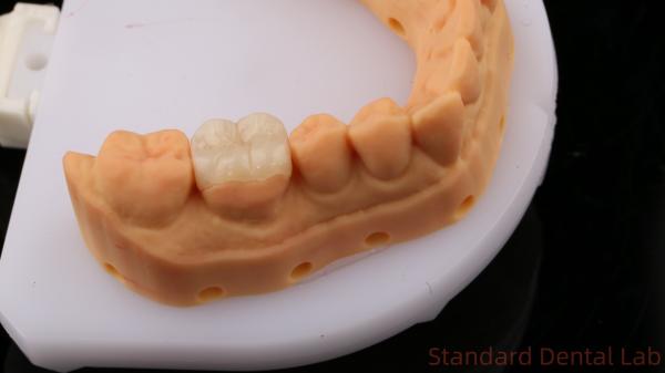 Translucency Zirconia Dental Inlay Onlay Crown For Restore Natural Cavity Shape