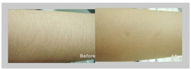 newest model amazing result ipl machine,ipl laser hair removal machine