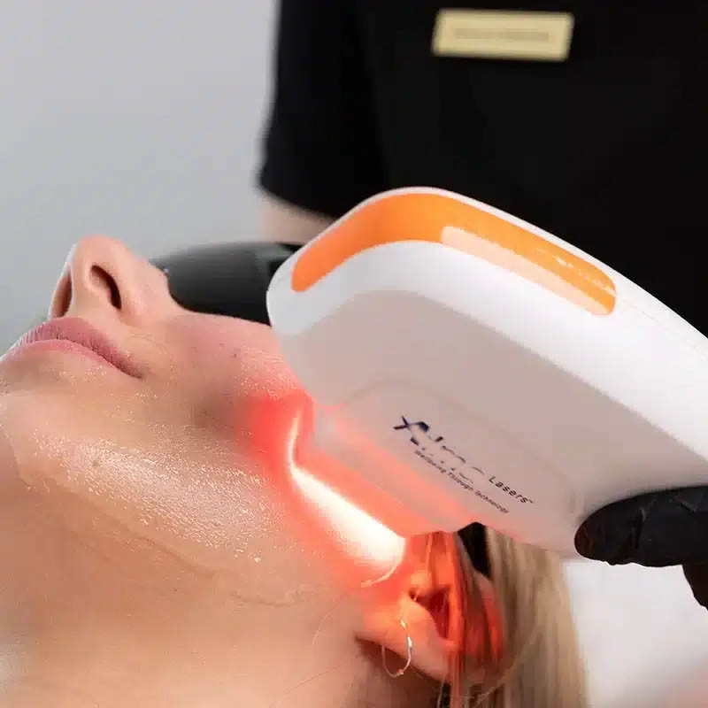 NIR Milk Light Whitening Hair Removal Machine Permanent Hair Remover Diode Laser 755 808 1064 Nm Diode Laser Hair Remover