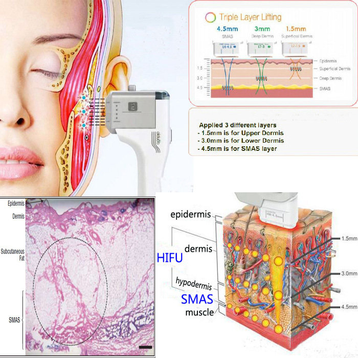 2015 new product CE approved hifu machine