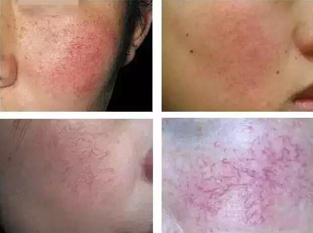 10-260ms 980nm Diode Laser Vascular Removal 20W Thread Vein Machine
