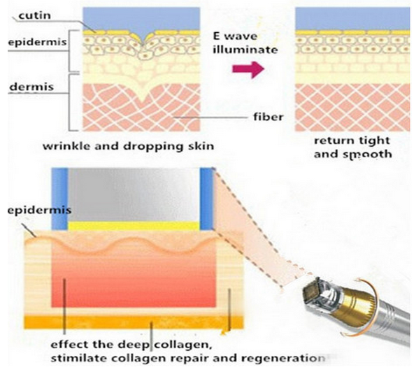 Top sale! best effect fractional rf microneedle / fractional needle rf system
