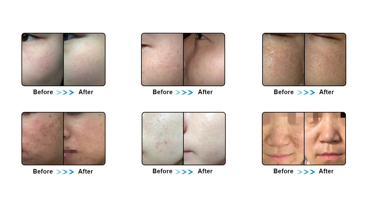 Professional Hair Removal Pigment Removal DPL Skin Rejuvenation Skin Tightening Laser Light Machine