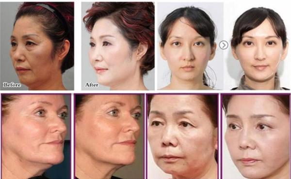 Face lift HIFU skin tightening wrinkle remover beauty machine
