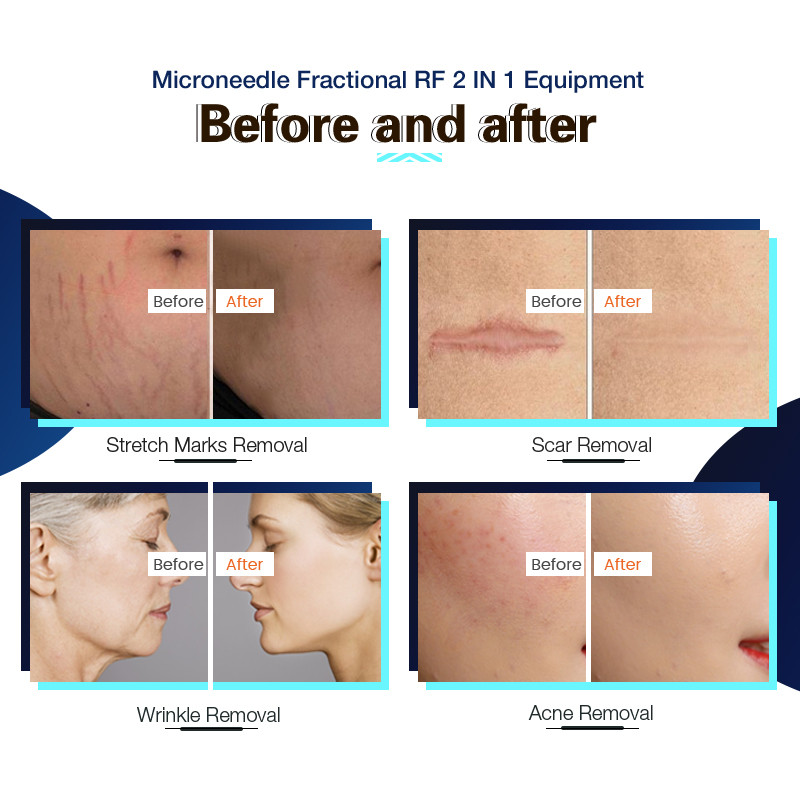 300W Stretch Mark Laser Removal Machine Fractional Micro Needling RF Machine