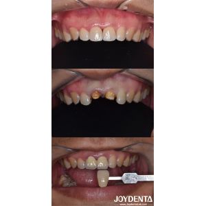  Biologically Oriented Preparation Technique Dental vertical Preparation Minimally Invasive Manufactures