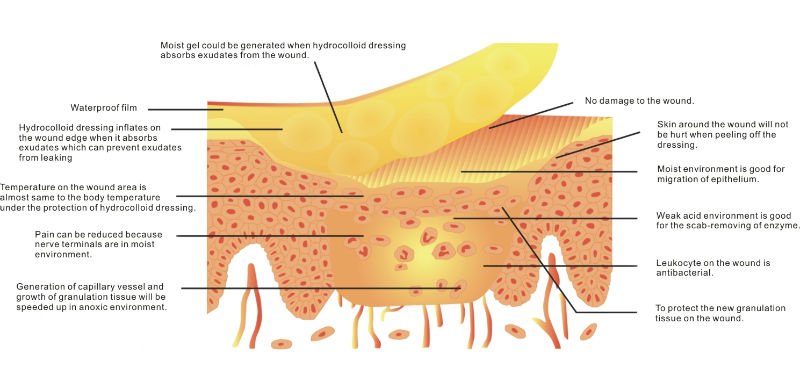 FDA CE Certificate Hydrocolloid Wound Dressing Patch For Wound Healing