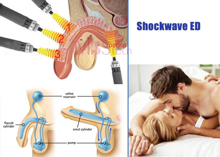 200mj Intelligent Extracorporeal Focused ED Shockwave Machine