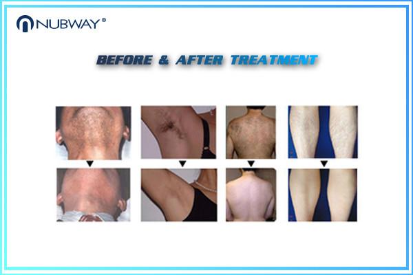 808nm painfree and permanent hair removal machine for salon