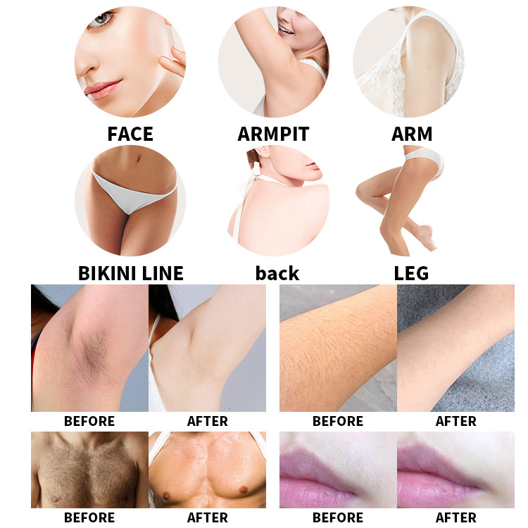 Cutting-Edge Diode Laser Hair Removal Machine for Flawless Skin