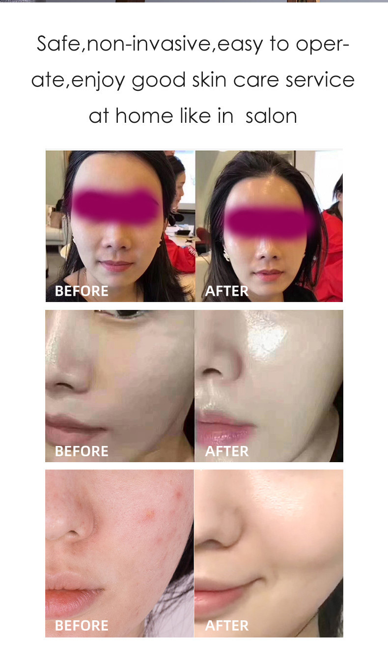 Shr Intense Pulsed Laser Hair Removal Machine 2000W Anti Puffiness