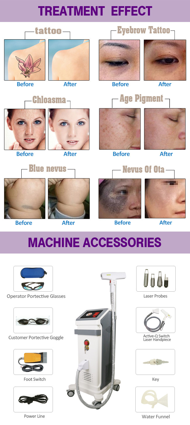 Picolaser 1064nm 532nm Picosecond Laser Q Switched Nd Yag Laser Tattoo Removal Machine Price