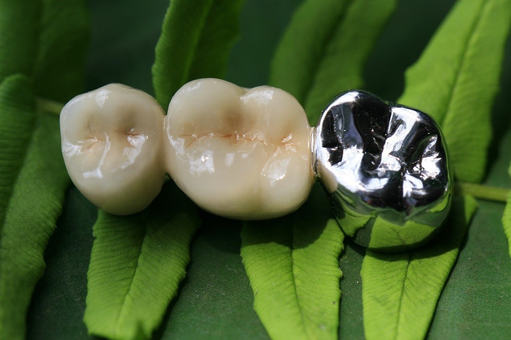Metal Ceramic Good Fitness PFM Dental Crown