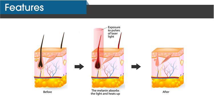 Big Power Pain Free Hair Removal Machine , Beauty IPL Machine OEM ODM
