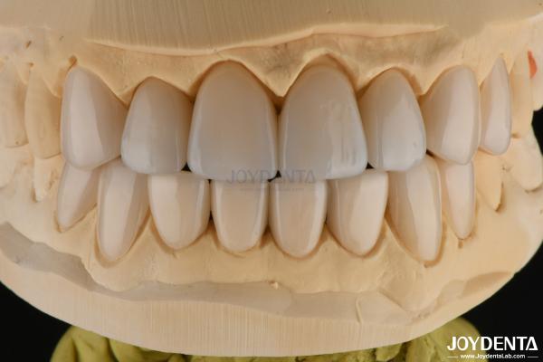 0.3-0.5mm Thick Feldspathic Porcelain Veneer High Fracture Resistance Upgrade