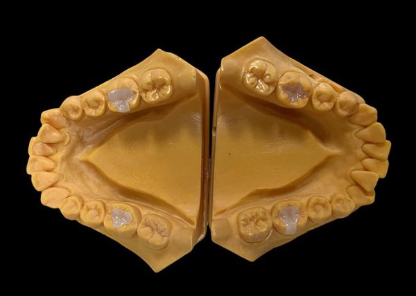Biocompatible Ceramic Inlays Onlays Seamless Dental Restoration with Stain