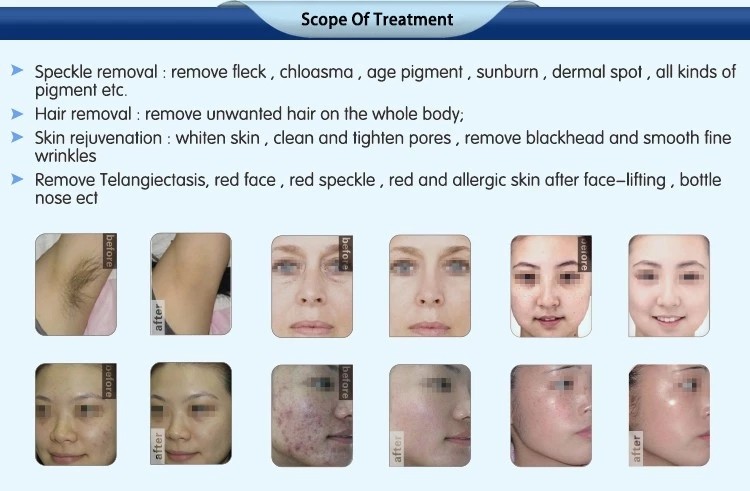 Best selling products 2018 multifunctional laser ipl shr hair removal machine OPT Optimal Pulse Technology