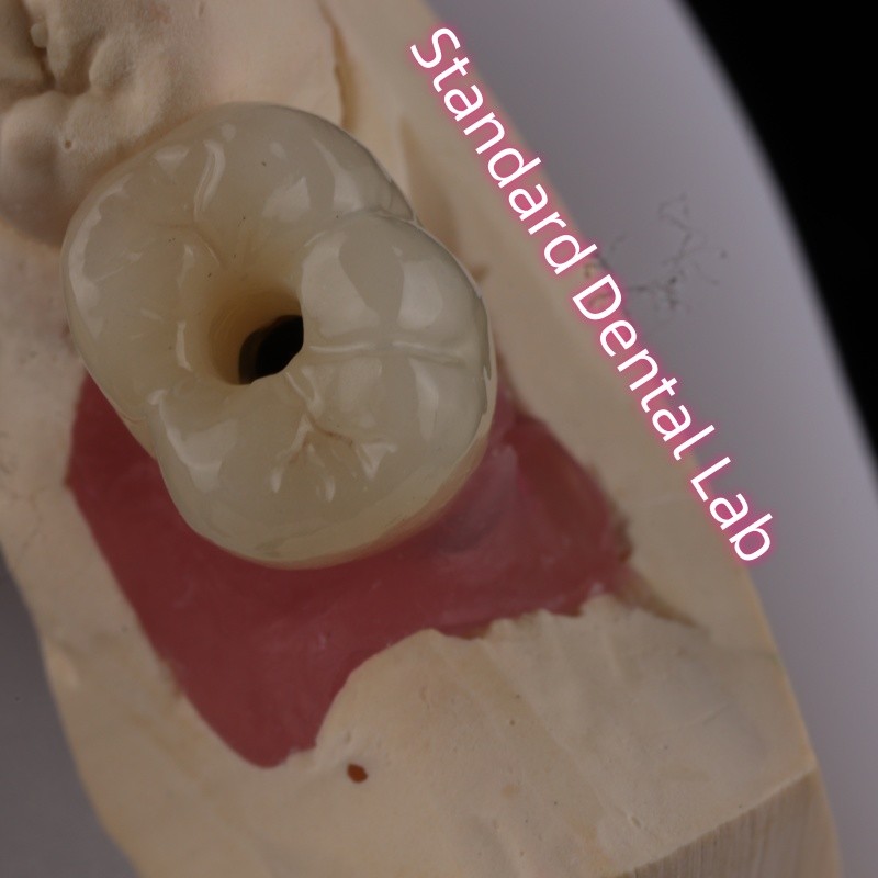Posterior Implant Crown Bruxier Solid Zirconia Screw Retained