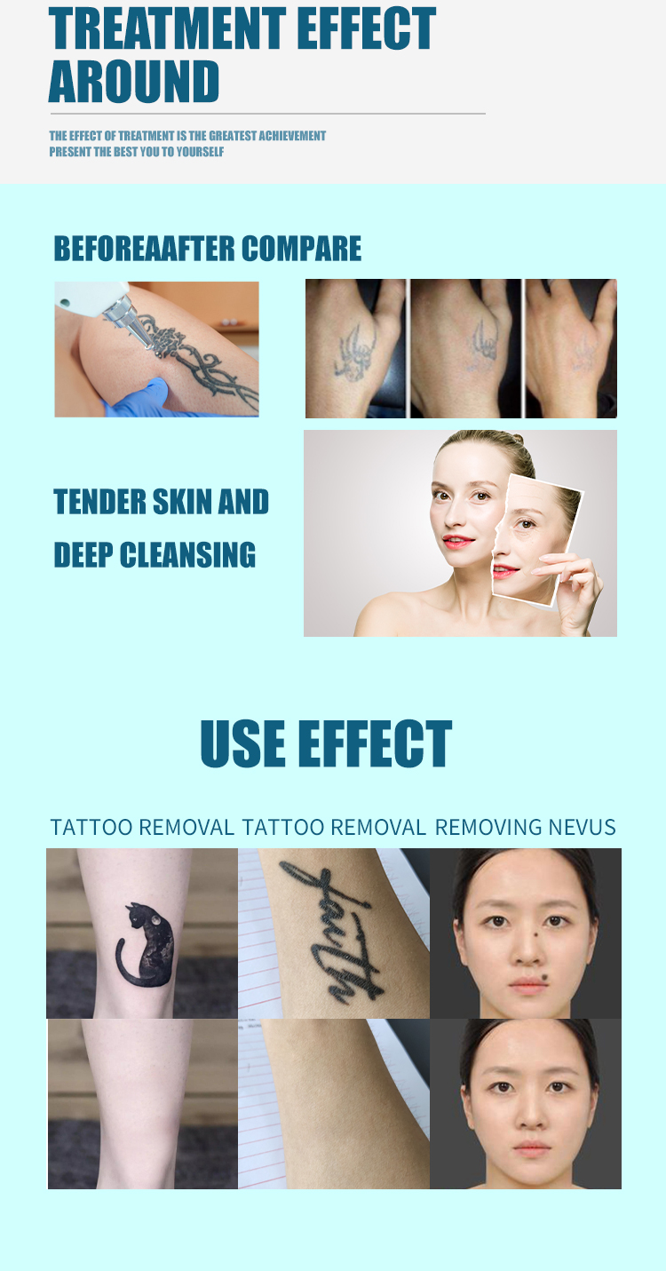 Medical Laser Hair Removal Equipment 755 808 940 1064nm Laser Hair Removal Machine Salon