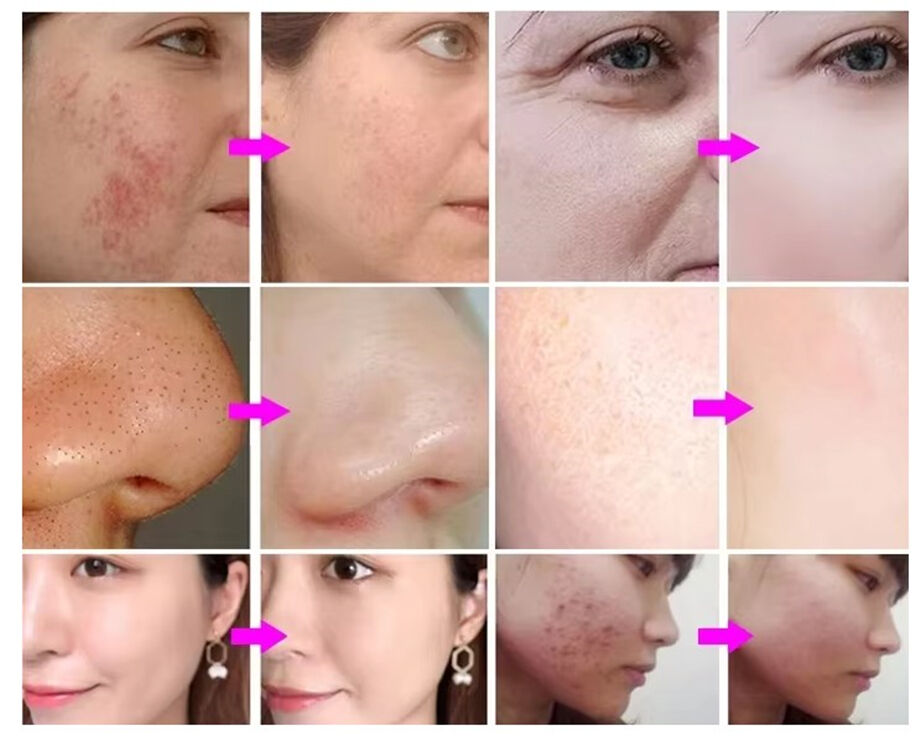 Hydra Peeling Facial hydro Small Bubble Water Hydro Aqua Facial h2o2 Hydra Machine