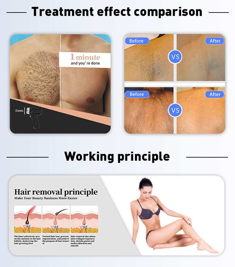 Triple Wavelengths Diode Laser Hair Removal Device 808nm 755nm 1064nm for Beauty Salon