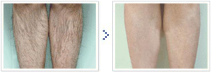 Newest Painless high power 808nm Diode Laser Hair Removal Machine for spa