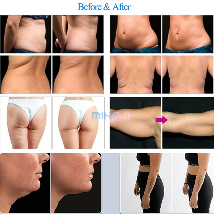 Home 80kpa Fat Freeze Cavitation Machine 360 Cryoskin Slimming Machine
