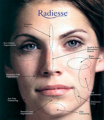 Radiess Is A Volumizing Calcium Hydroxlyapatite Filler That Treats Deep Folds