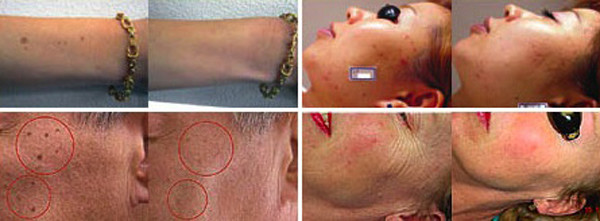 FDA approved ipl laser machine ipl laser hair removel machine for sale lumenis ipl quantum