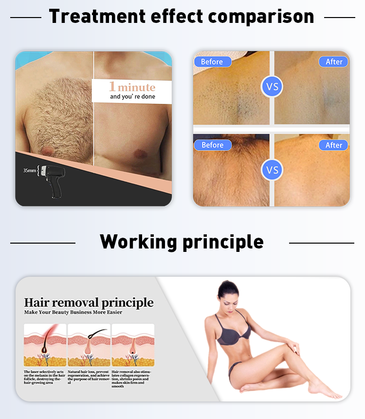 Japan TEC Cooling System 1200w portable 808 755 1064 diode laser hair removal machine