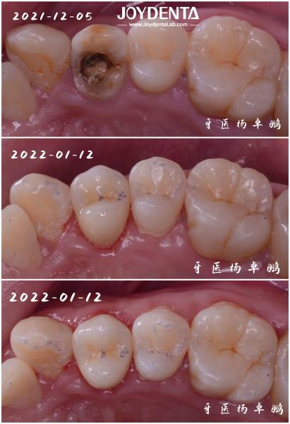 Accurate Fit Dental Porcelain Inlay Damaged Teeth Restoration For Adults And