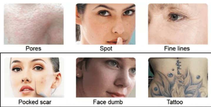 1-10Hz picocare laser tattoo removal machine 2mm 3mm