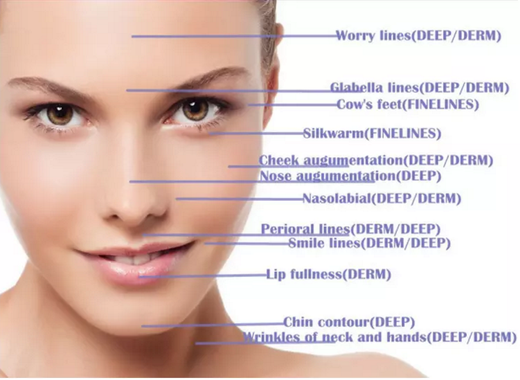 1ml Fine Fosyderm Hyaluronic Acid Dermal Filler Remove Fine Lines