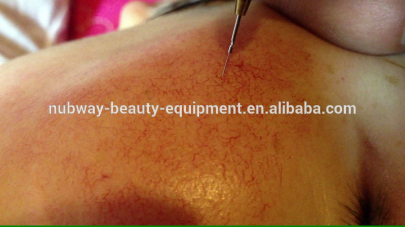 Factory direct sale healthy Spider Veins Facial Vascular Lesions Removal Machine