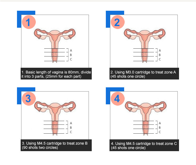 Painless Sama 4d 3d Hifu Machine Pressure Testor 4.5 Mm Cartridge Vaginal Probes