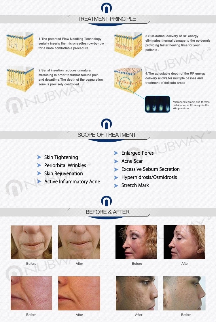 Factory price skin rejuvenation acne treatment fractional rf microneedle scarlet device